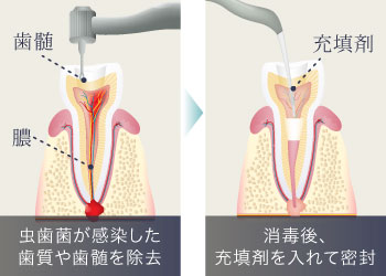 虫歯菌が感染した歯質や歯髄を除去し、消毒後、充填剤を入れて密封